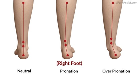 orthopedic slippers an excellent choice - depiction of various foot pronations