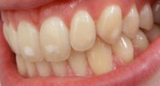 teeth affected by dental fluorosis