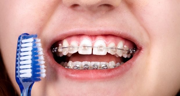 help your kids brush with braces-a kid with braces holding a toothbrush