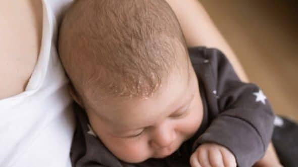 common hair problems in kids-a mom holding a baby with dandruff