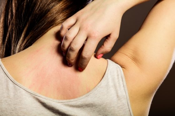 signs your home is making you sick- a woman with skin allergies