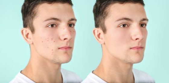 Easy skin care routine for kids-before and after photo of a clear skin
