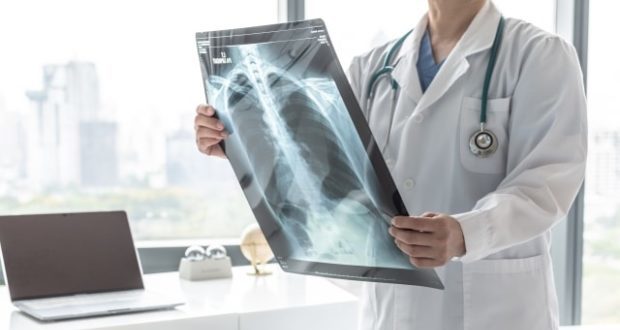 Lung cancer in men- A doctor looking at an X-ray