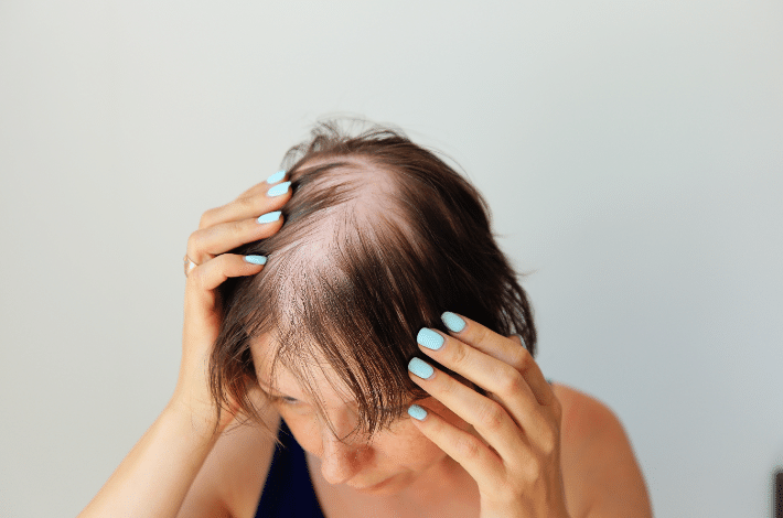 Modern hair loss treatments - a woman with thinning hair