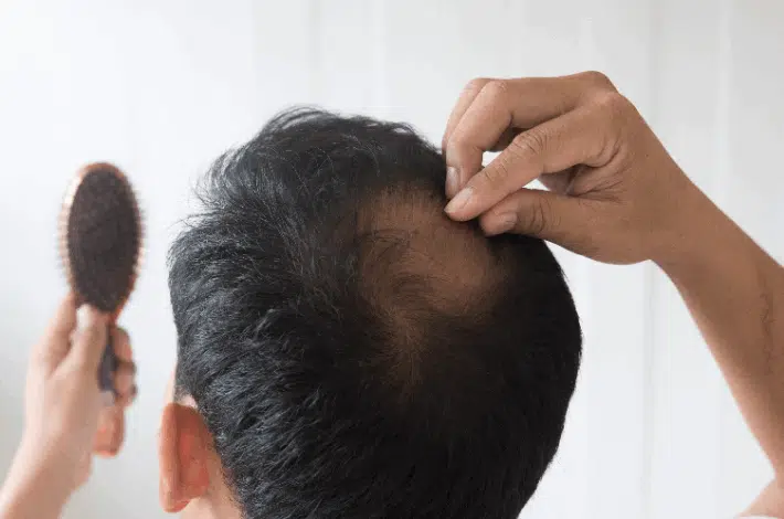 Effective Tips For Thinning Hair - a man examining the bald spot at the top of his head
